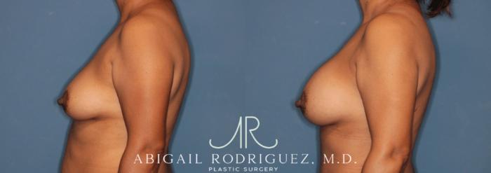 Before & After Breast Augmentation Case 346003 Left Side View in Houston, TX