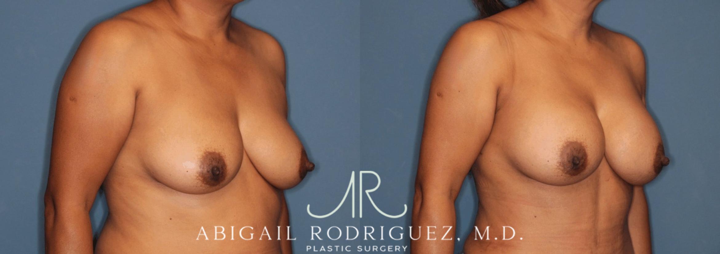 Before & After Breast Augmentation Case 346003 Right Oblique View in Houston, TX