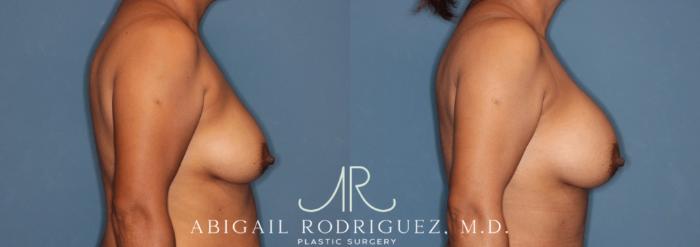 Before & After Breast Augmentation Case 346003 Right Side View in Houston, TX