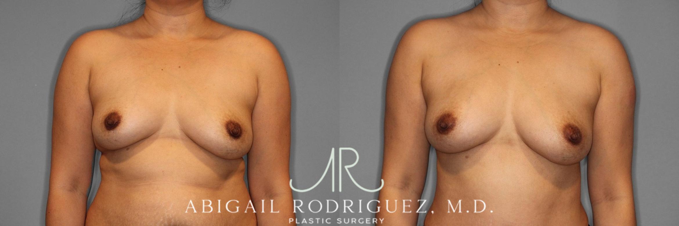 Before & After Breast Augmentation with Fat Grafting Case 345994 Front View in Houston, TX