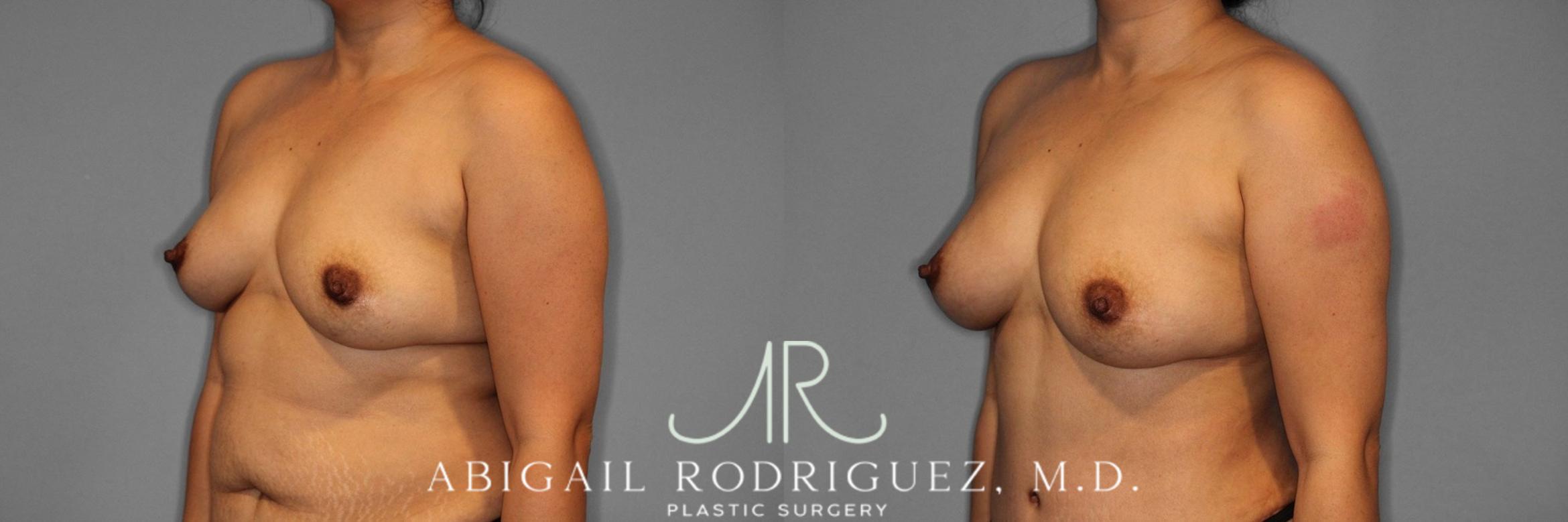 Before & After Breast Augmentation with Fat Grafting Case 345994 Left Oblique View in Houston, TX
