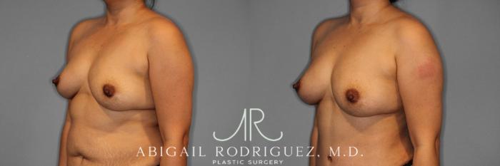 Before & After Breast Augmentation with Fat Grafting Case 345994 Left Oblique View in Houston, TX