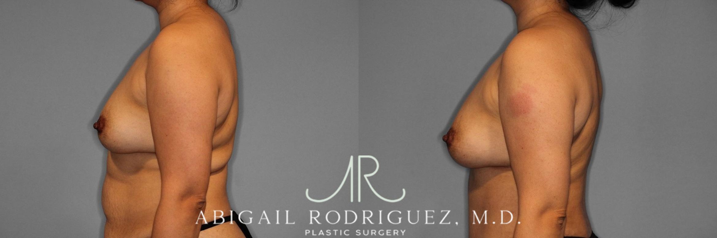 Before & After Breast Augmentation with Fat Grafting Case 345994 Left Side View in Houston, TX