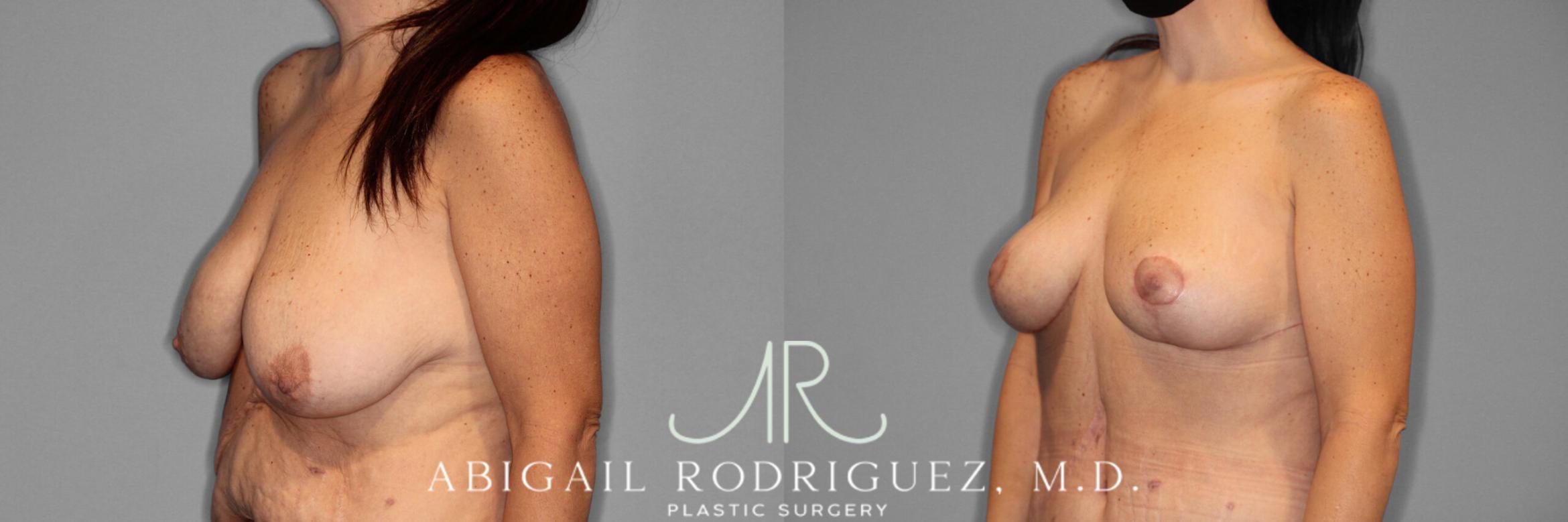 Before & After Breast Lift Case 254029 View 2 View in Houston, TX