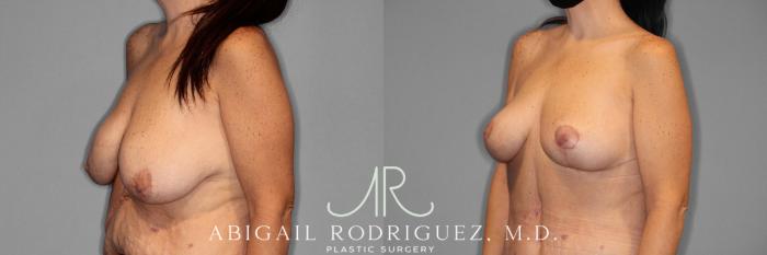 Before & After Breast Lift Case 254029 View 2 View in Houston, TX