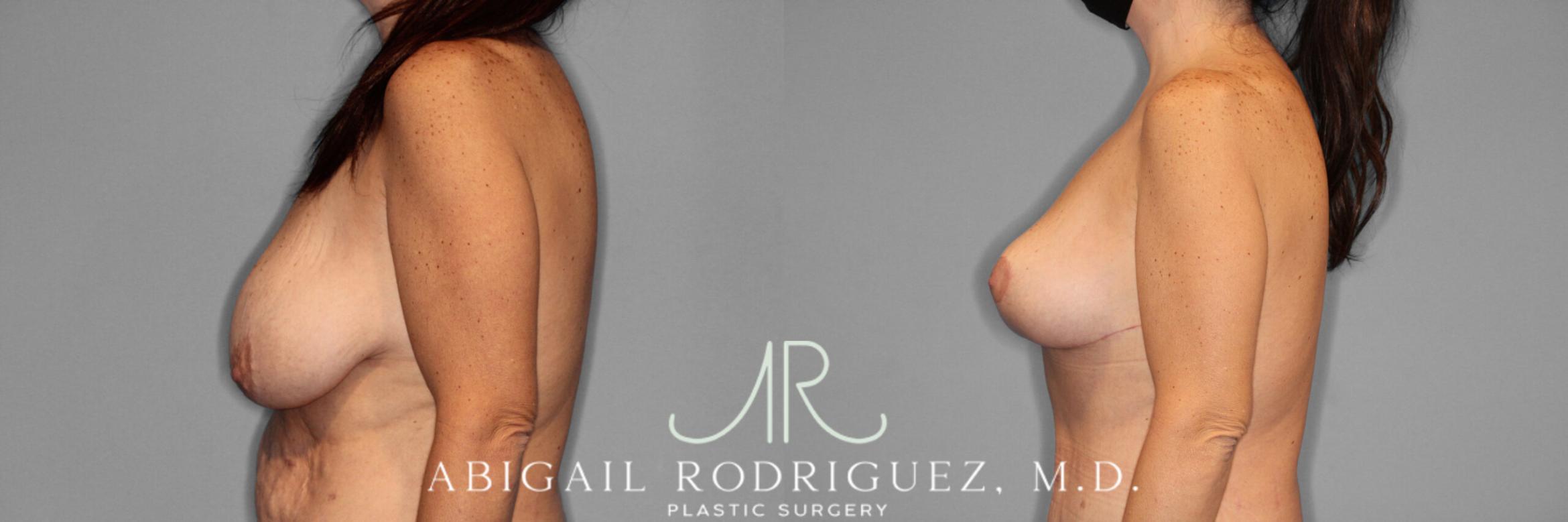 Before & After Breast Lift Case 254029 View 3 View in Houston, TX