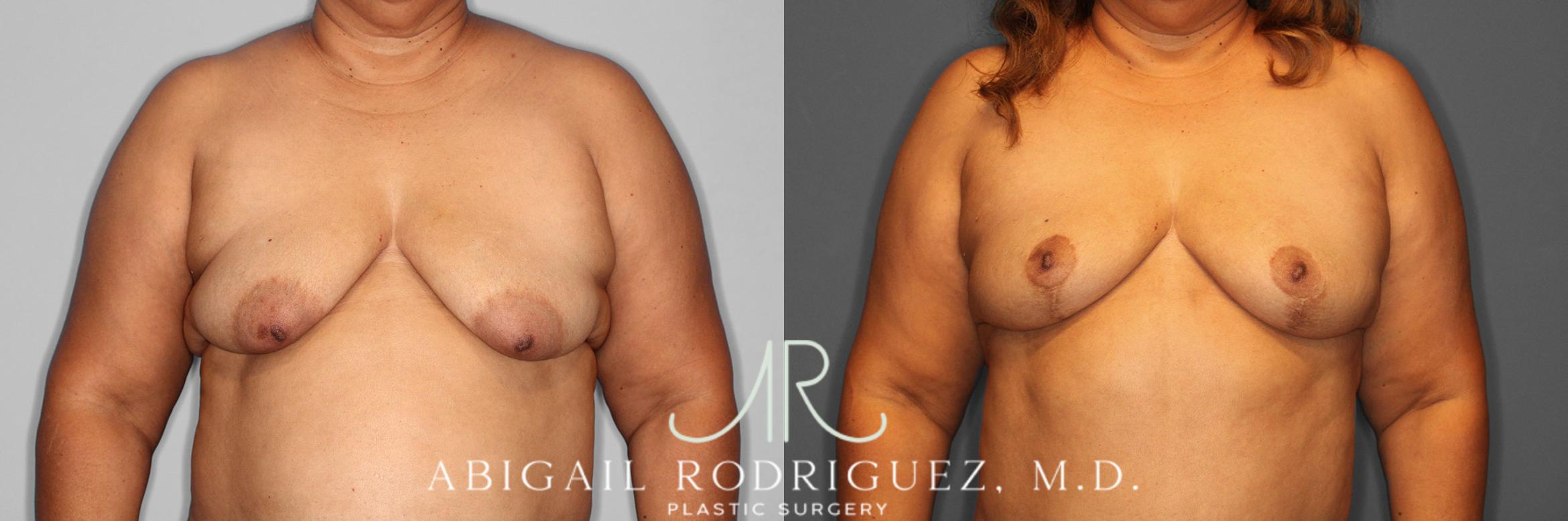 Before & After Breast Lift Case 254548 View 1 View in Houston, TX