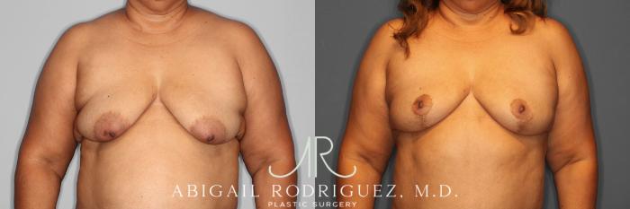 Before & After Liposuction Case 254548 View 1 View in Houston, TX