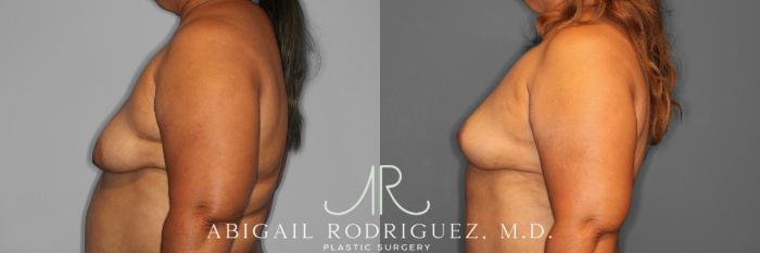 Before & After Breast Lift Case 254548 View 2 View in Houston, TX