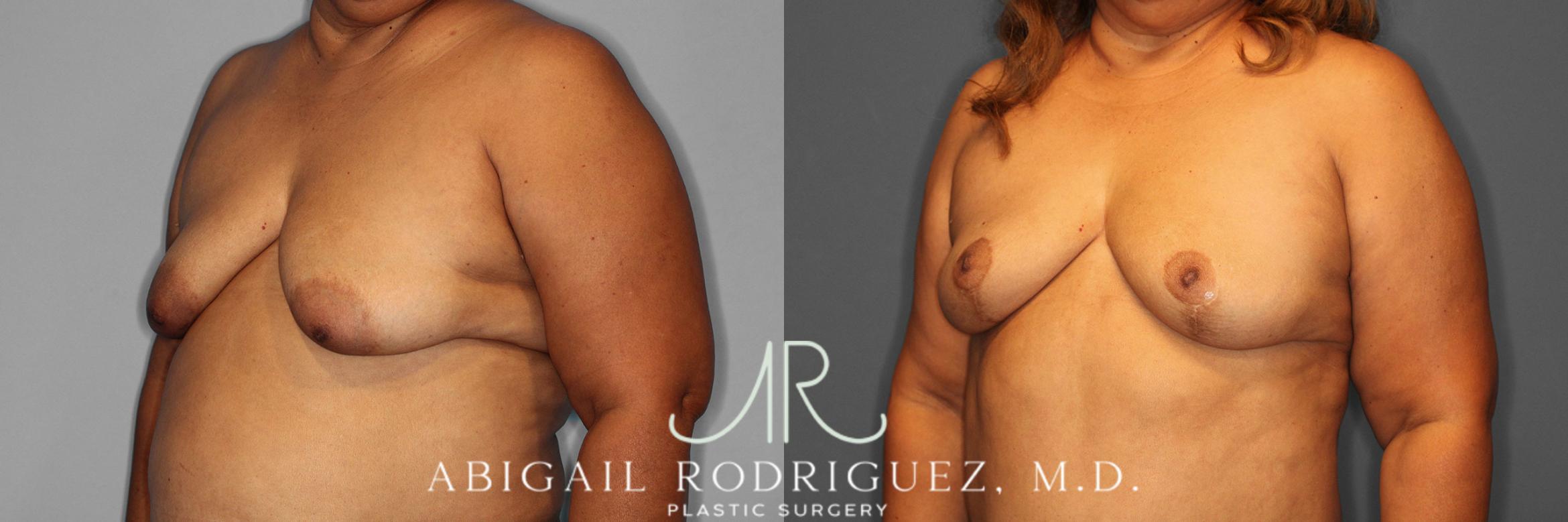 Before & After Breast Lift Case 254548 View 3 View in Houston, TX