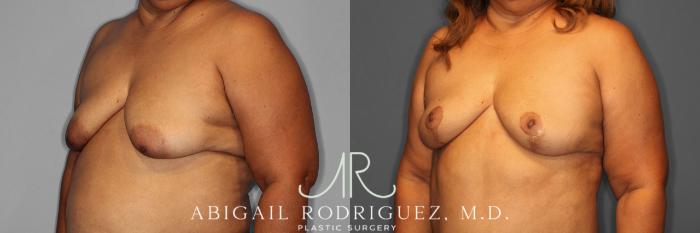 Before & After Breast Lift Case 254548 View 3 View in Houston, TX
