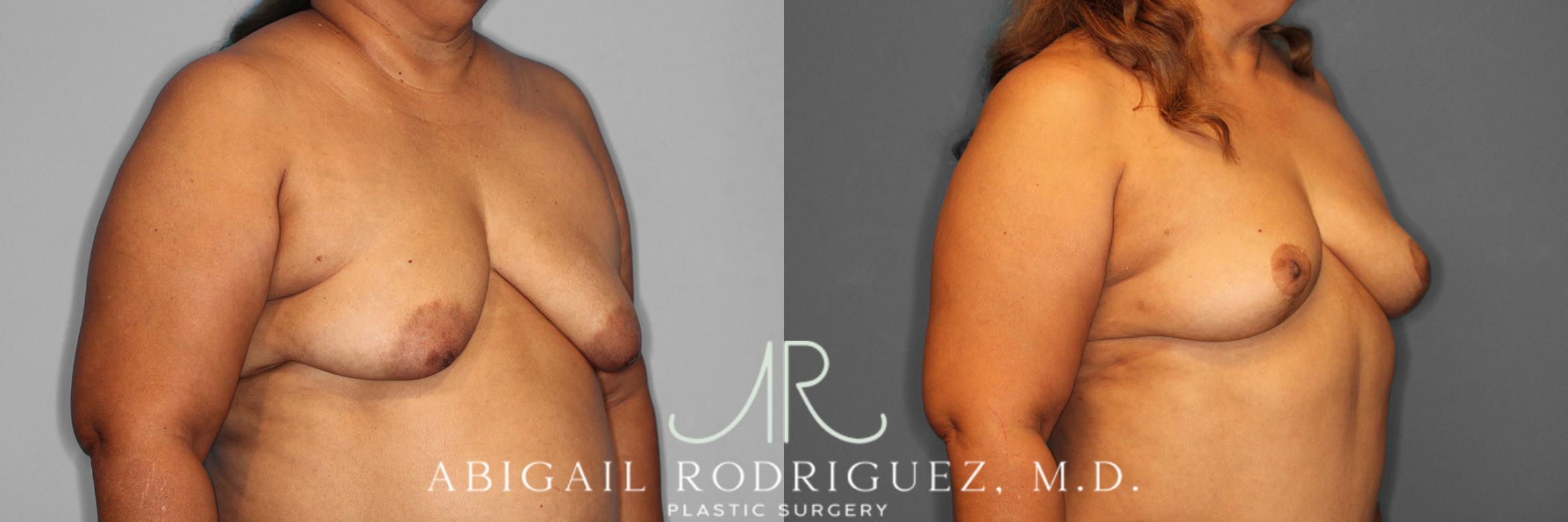 Before & After Breast Lift Case 254548 View 4 View in Houston, TX