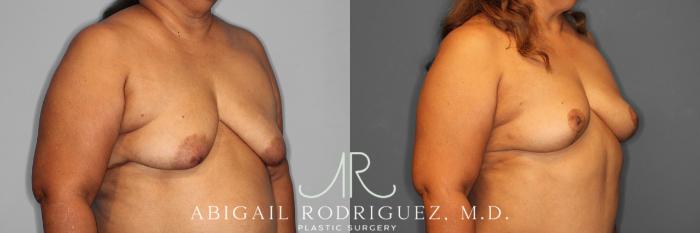 Before & After Breast Lift Case 254548 View 4 View in Houston, TX