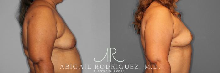 Before & After Breast Lift Case 254548 View 5 View in Houston, TX