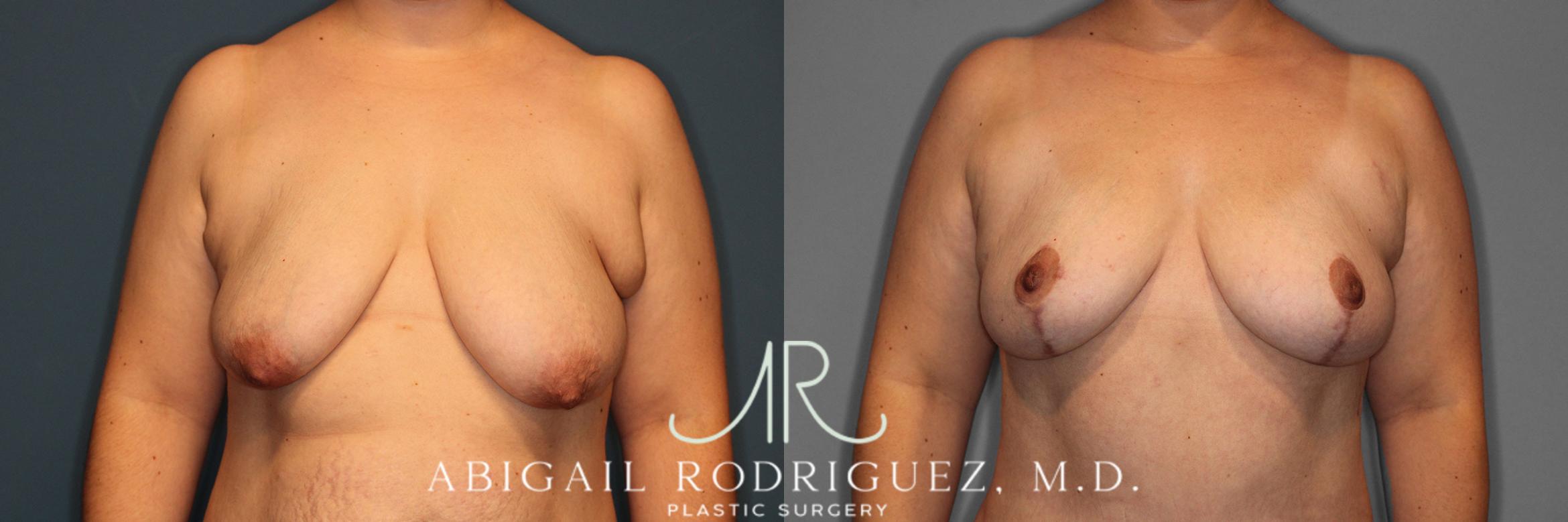 Before & After Breast Lift Case 257370 View 1 View in Houston, TX