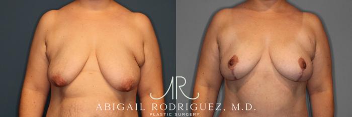 Before & After Breast Lift Case 257370 View 1 View in Houston, TX