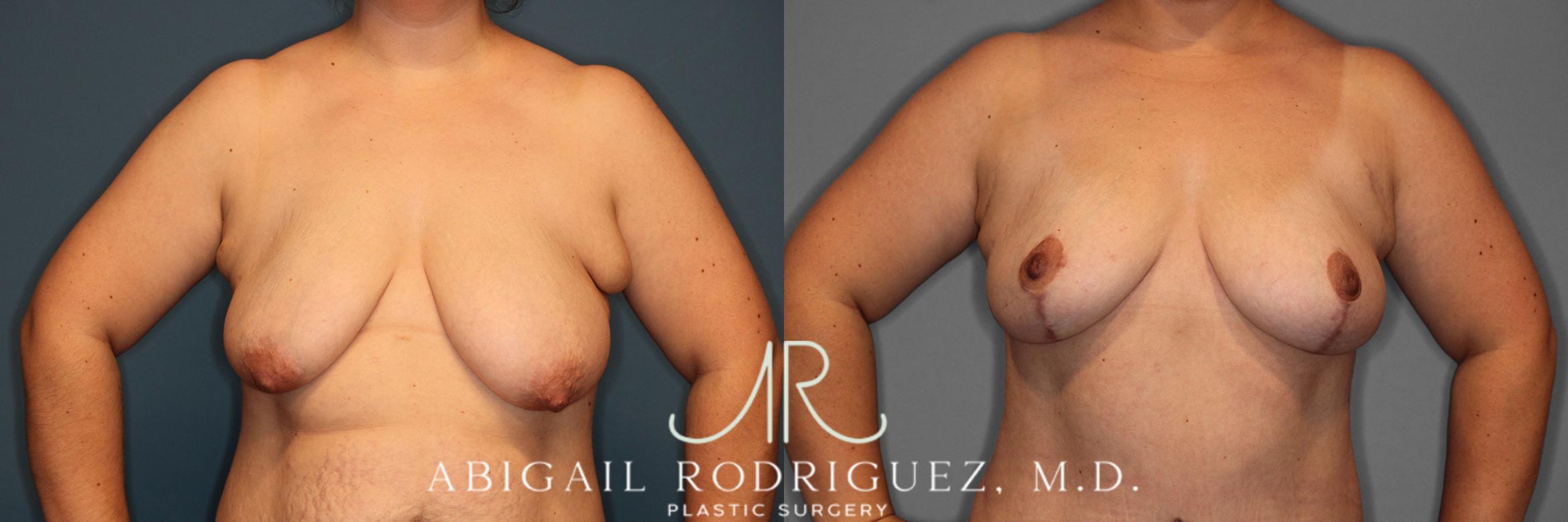 Before & After Breast Lift Case 257370 View 2 View in Houston, TX