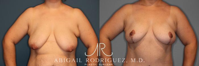 Before & After Breast Lift Case 257370 View 2 View in Houston, TX