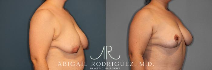 Before & After Breast Lift Case 257370 View 3 View in Houston, TX