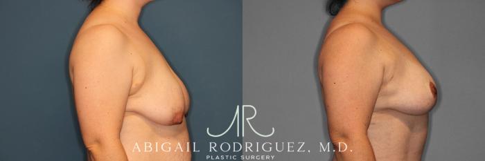Before & After Breast Lift Case 257370 View 4 View in Houston, TX