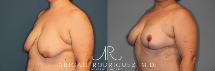 Before & After Breast Lift Case 257370 View 5 View in Houston, TX