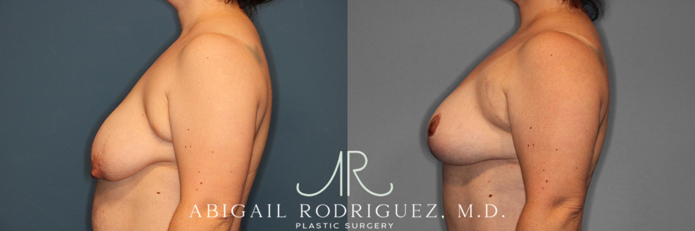 Before & After Breast Lift Case 257370 View 6 View in Houston, TX
