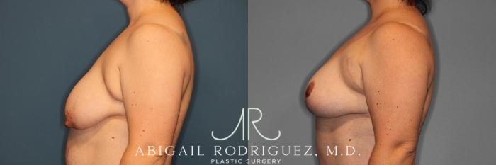 Before & After Breast Lift Case 257370 View 6 View in Houston, TX
