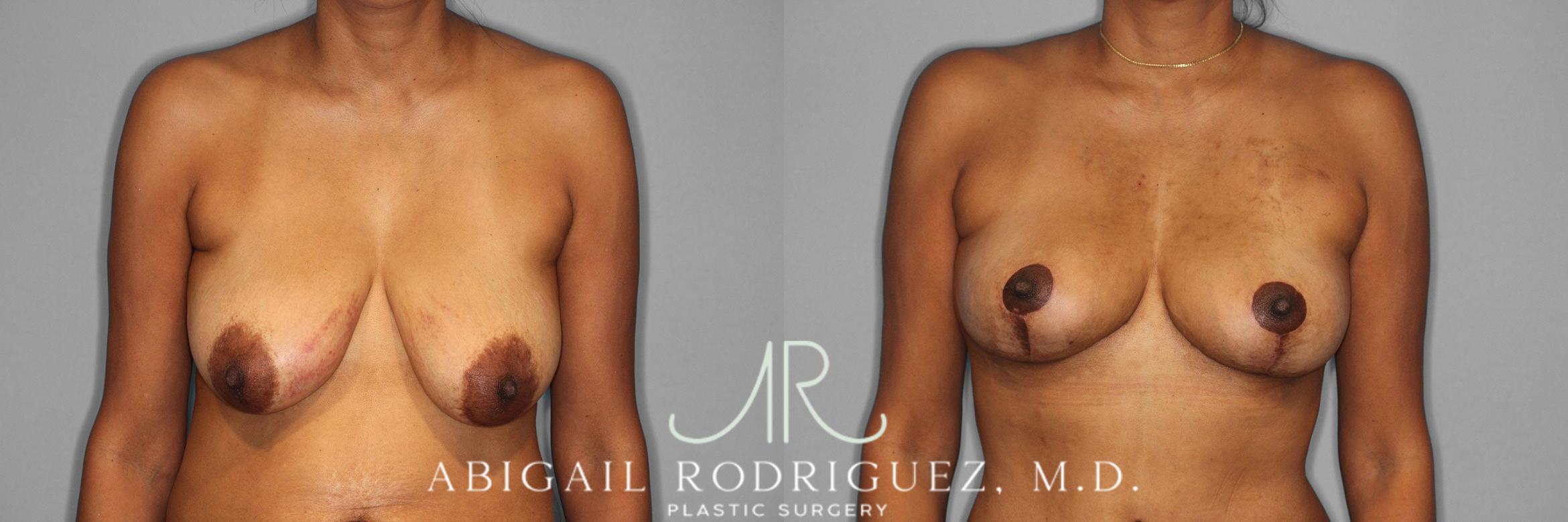 Before & After Breast Lift Case 258398 View 1 View in Houston, TX