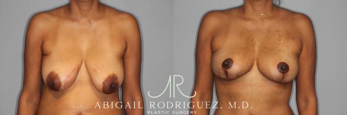 Before & After Breast Lift Case 258398 View 1 View in Houston, TX