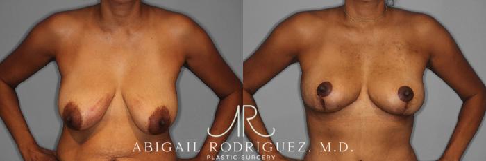 Before & After Breast Lift Case 258398 View 2 View in Houston, TX
