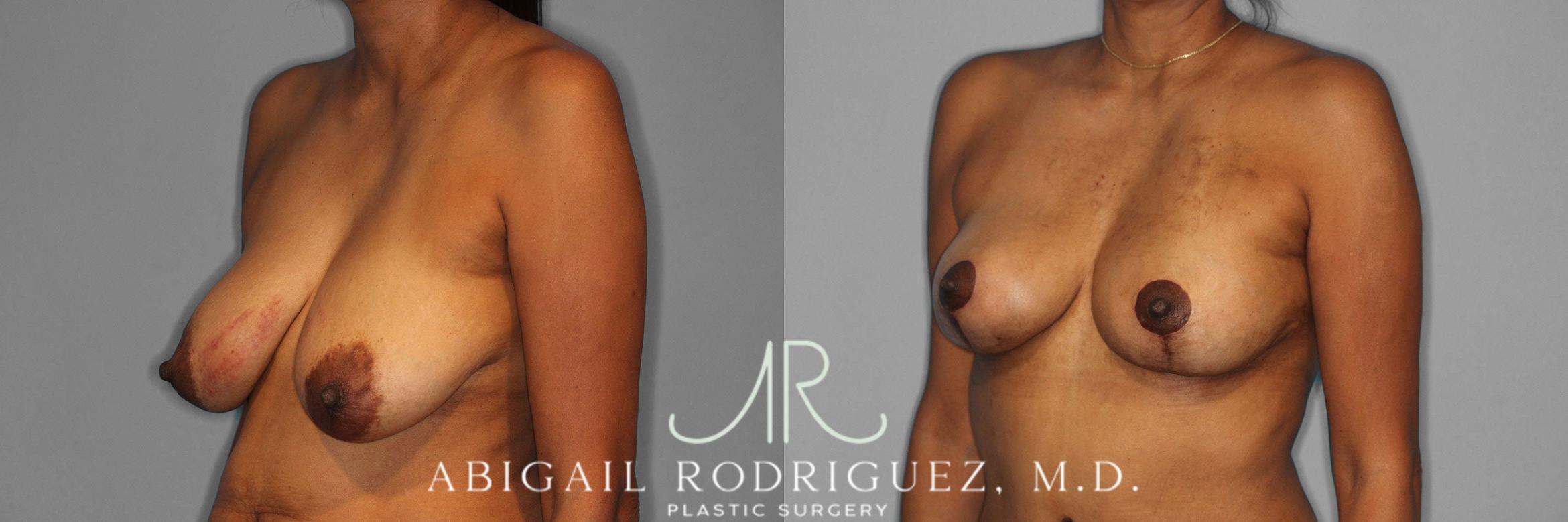 Before & After Breast Lift Case 258398 View 3 View in Houston, TX