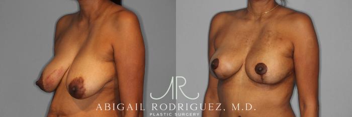 Before & After Breast Lift Case 258398 View 3 View in Houston, TX