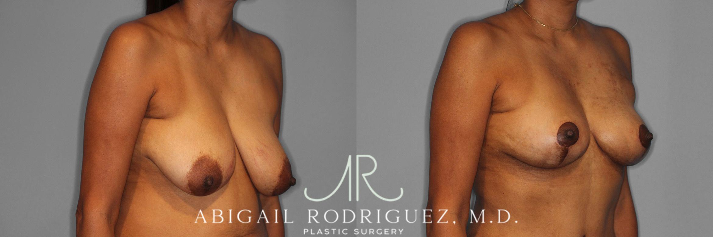 Before & After Breast Lift Case 258398 View 5 View in Houston, TX