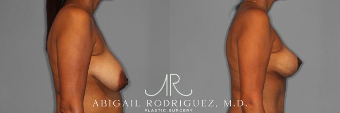 Before & After Breast Lift Case 258398 View 6 View in Houston, TX