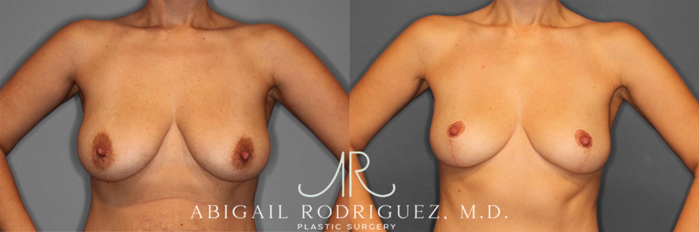 Before & After Breast Lift Case 258469 View 1 View in Houston, TX