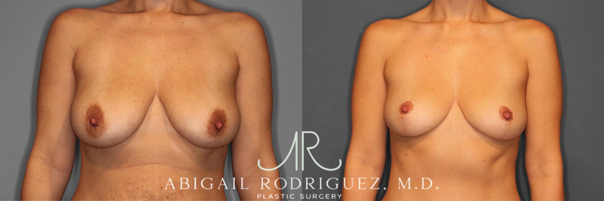 Before & After Breast Lift Case 258469 View 2 View in Houston, TX