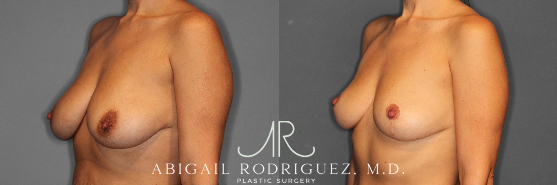 Before & After Breast Lift Case 258469 View 3 View in Houston, TX