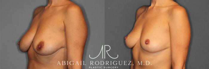Before & After Breast Lift Case 258469 View 3 View in Houston, TX