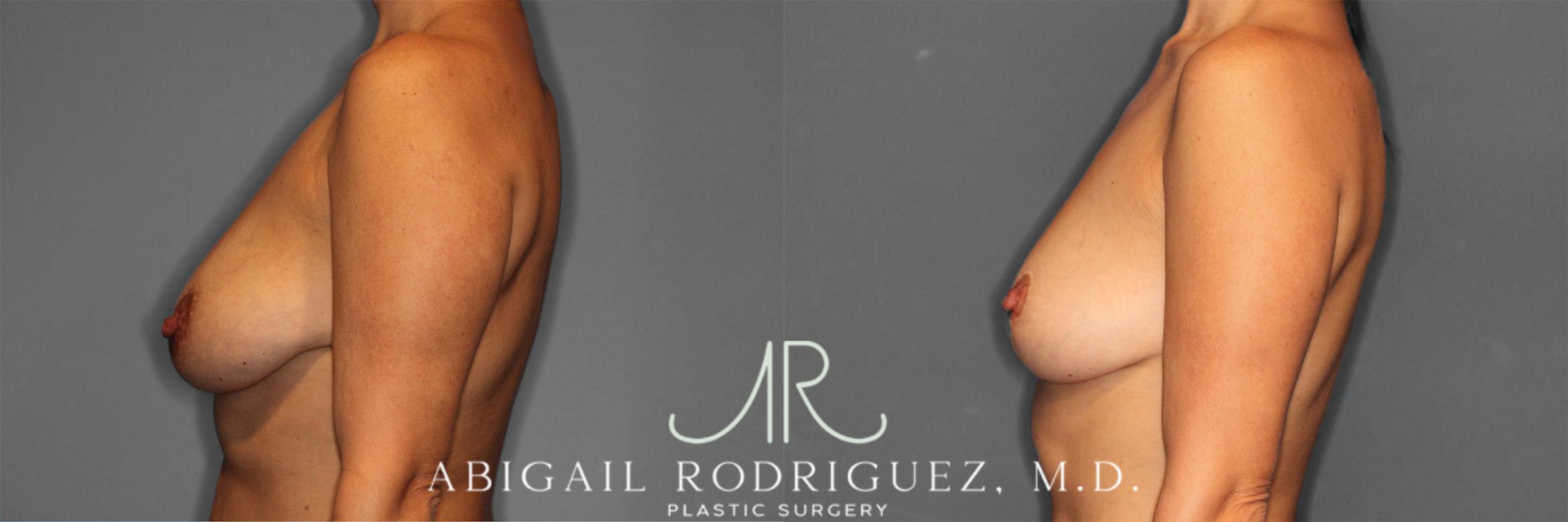 Before & After Breast Lift Case 258469 View 4 View in Houston, TX