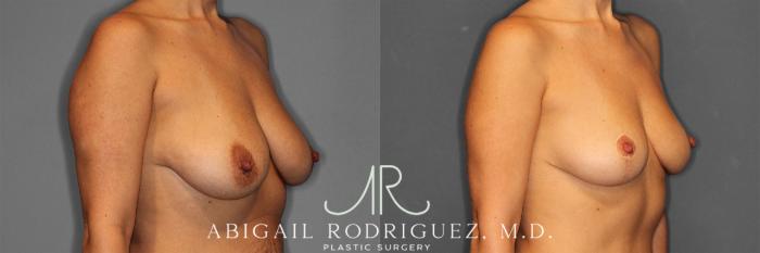 Before & After Breast Lift Case 258469 View 5 View in Houston, TX