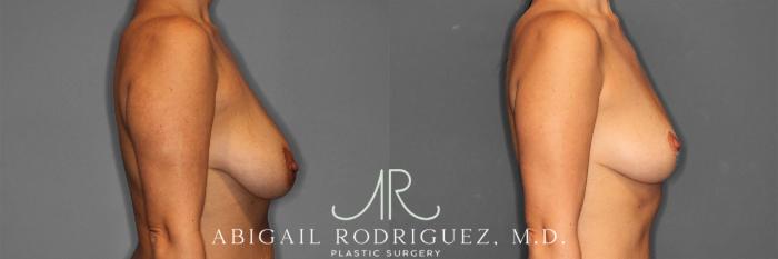 Before & After Breast Lift Case 258469 View 6 View in Houston, TX