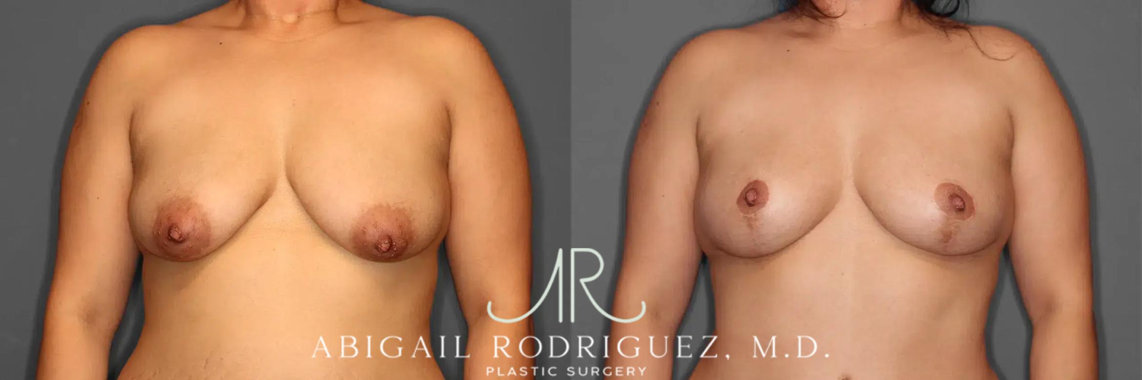 Before & After Breast Lift Case 259102 View 1 View in Houston, TX