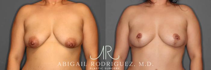 Before & After Breast Lift Case 259102 View 1 View in Houston, TX