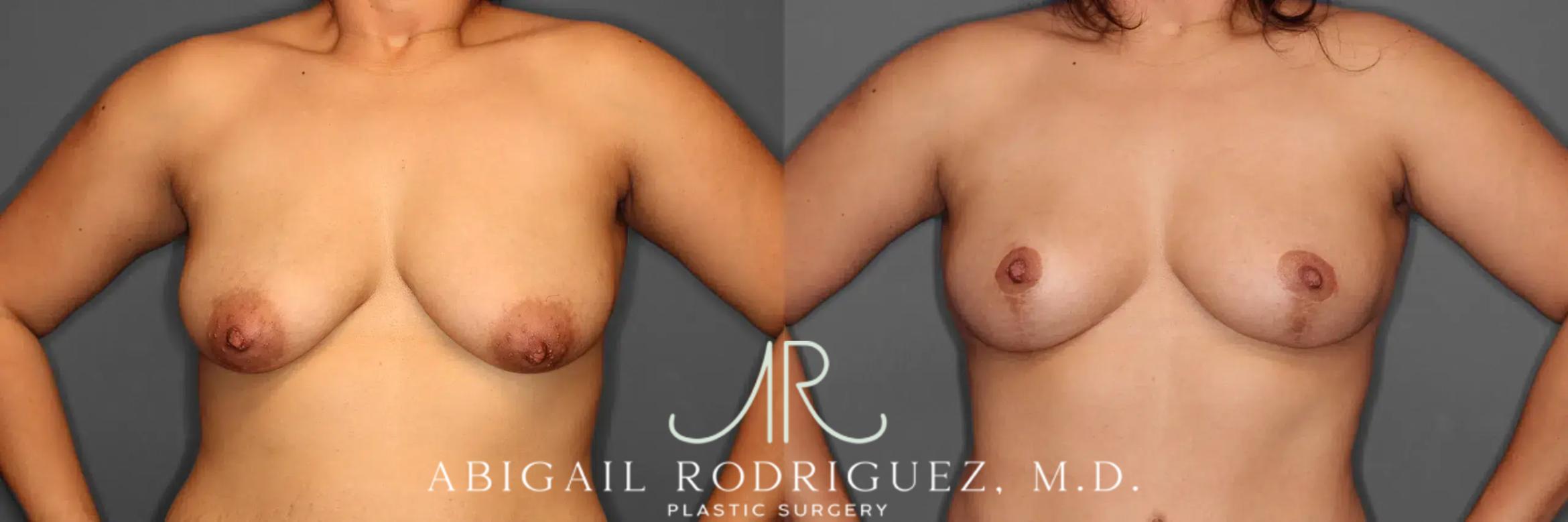 Before & After Breast Lift Case 259102 View 2 View in Houston, TX