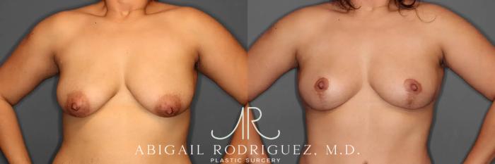 Before & After Breast Lift Case 259102 View 2 View in Houston, TX