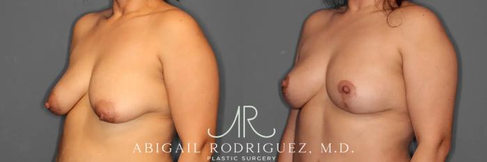 Before & After Breast Lift Case 259102 View 3 View in Houston, TX