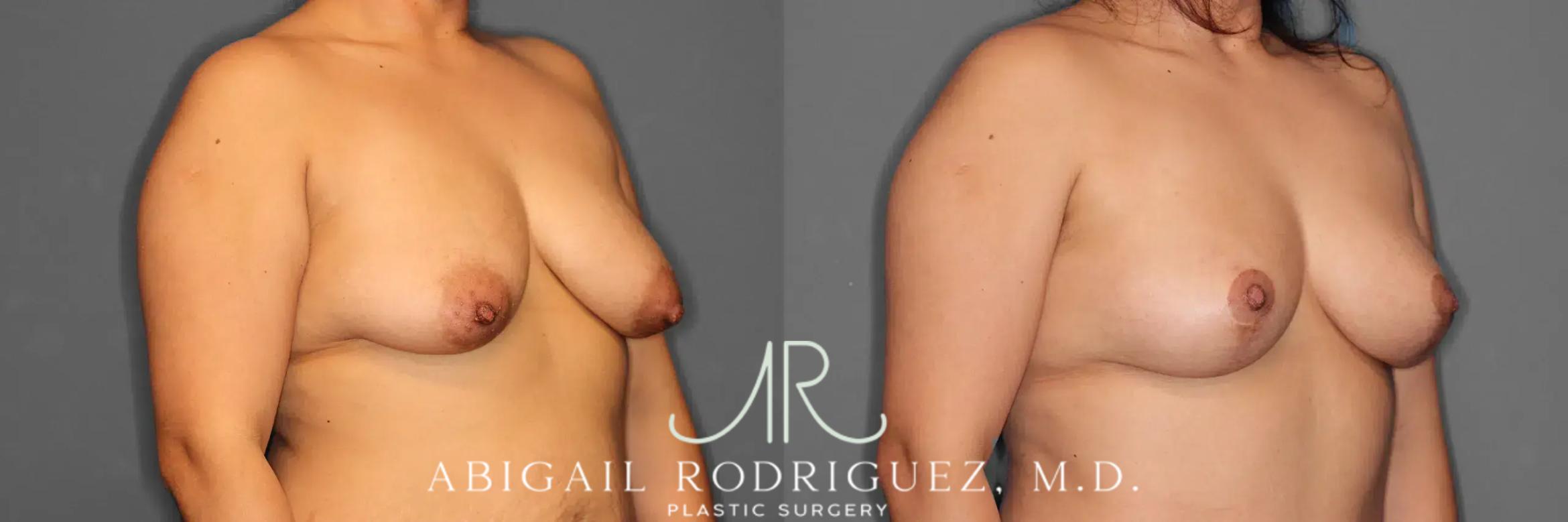 Before & After Breast Lift Case 259102 View 5 View in Houston, TX