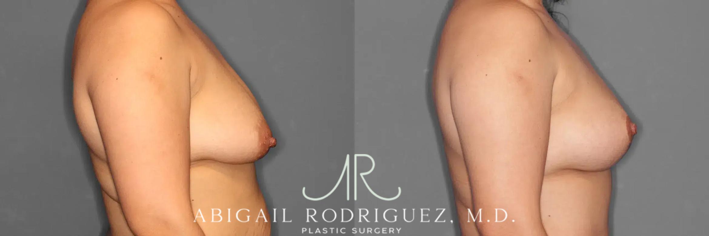 Before & After Breast Lift Case 259102 View 6 View in Houston, TX