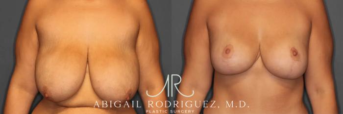 Before & After Breast Lift Case 259235 View 1 View in Houston, TX