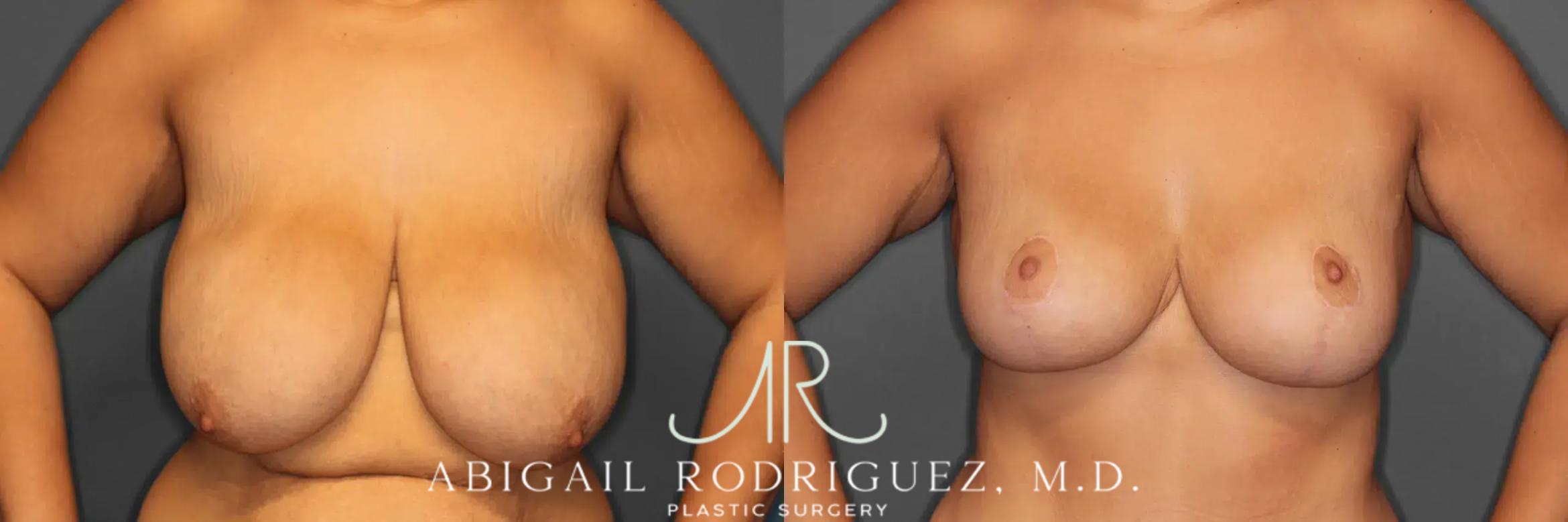 Before & After Breast Lift Case 259235 View 2 View in Houston, TX